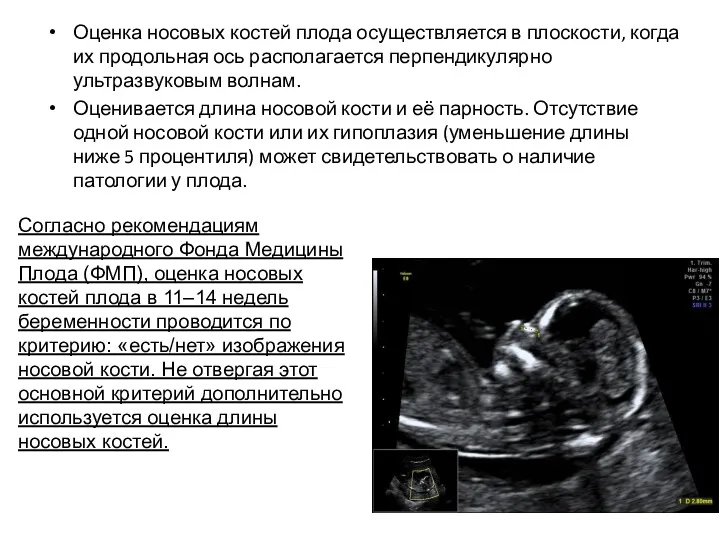 Оценка носовых костей плода осуществляется в плоскости, когда их продольная