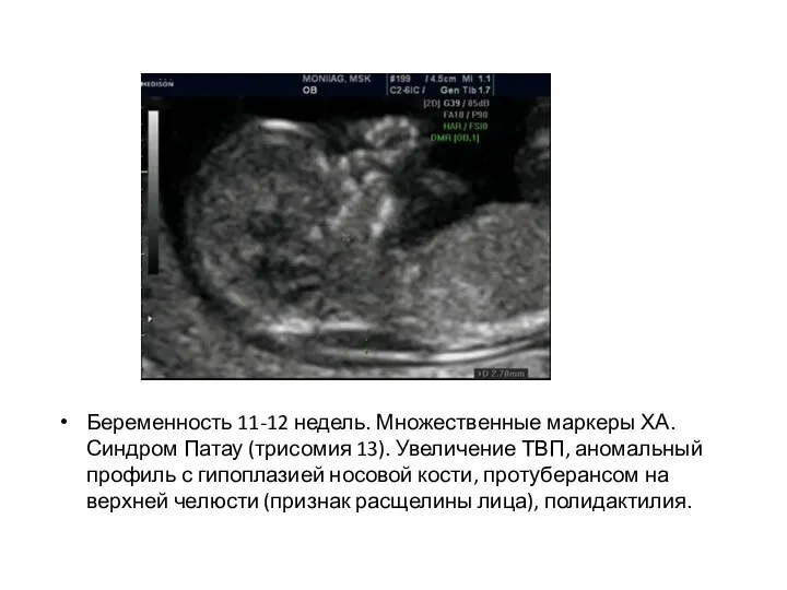 Беременность 11-12 недель. Множественные маркеры ХА. Синдром Патау (трисомия 13).