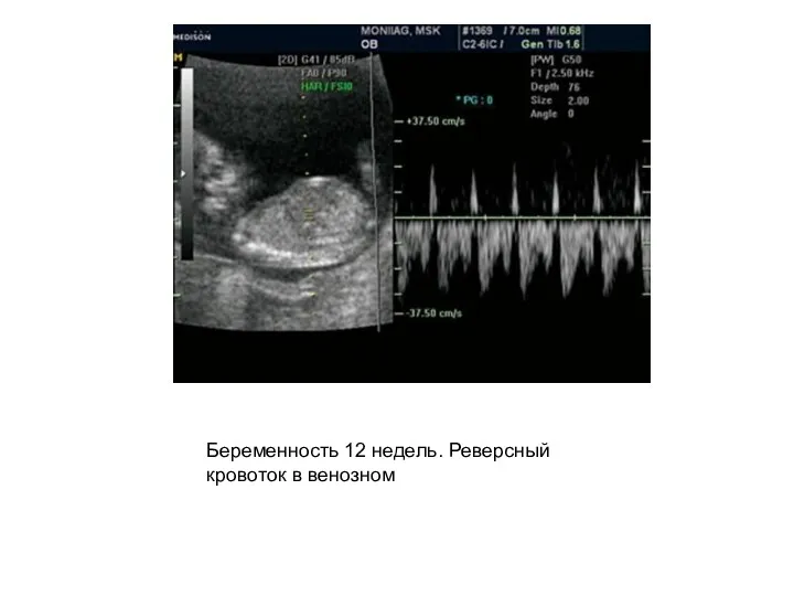 Беременность 12 недель. Реверсный кровоток в венозном