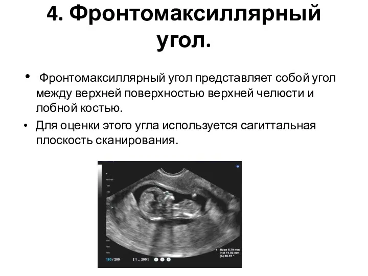 4. Фронтомаксиллярный угол. Фронтомаксиллярный угол представляет собой угол между верхней