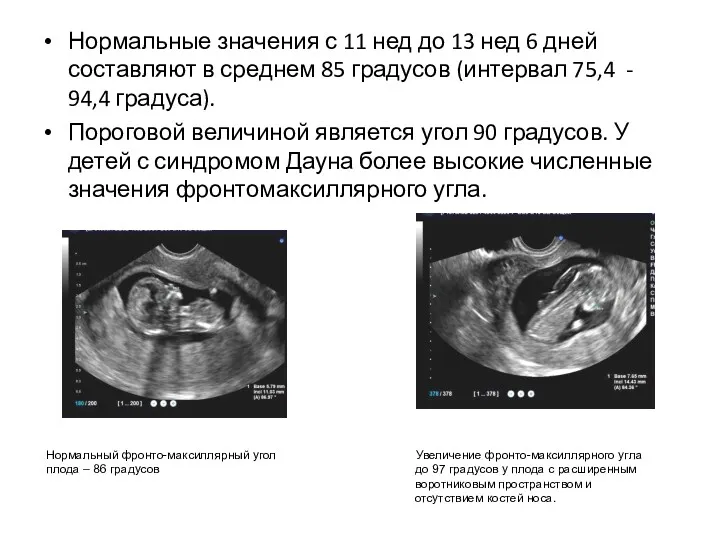 Нормальные значения с 11 нед до 13 нед 6 дней