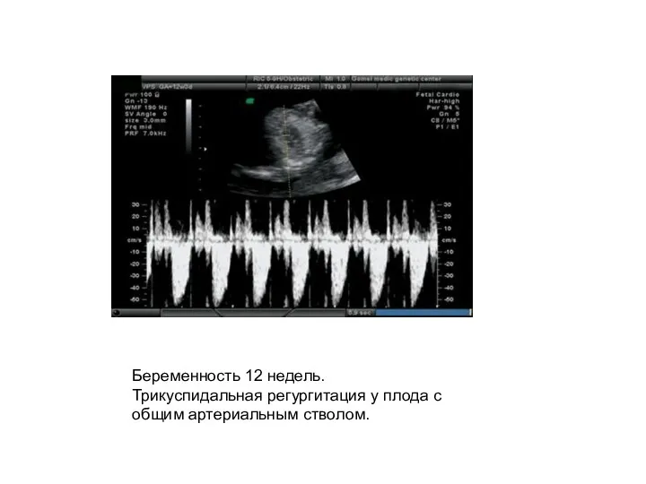 Беременность 12 недель. Трикуспидальная регургитация у плода с общим артериальным стволом.