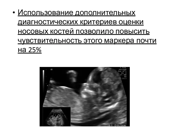 Использование дополнительных диагностических критериев оценки носовых костей позволило повысить чувствительность этого маркера почти на 25%