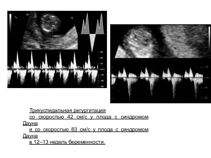Трикуспидальная регургитация со скоростью 42 см/с у плода с синдромом