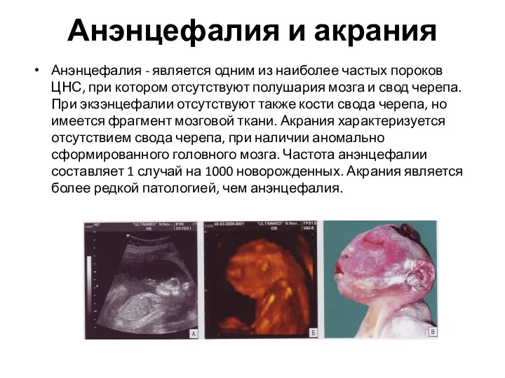 Анэнцефалия и акрания Анэнцефалия - является одним из наиболее частых