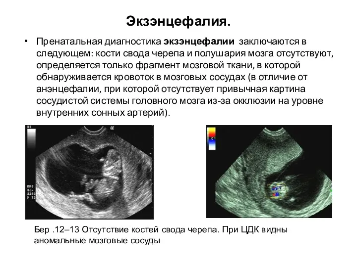 Экзэнцефалия. Пренатальная диагностика экзэнцефалии заключаются в следующем: кости свода черепа