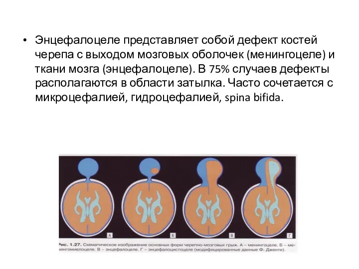 Энцефалоцеле представляет собой дефект костей черепа с выходом мозговых оболочек