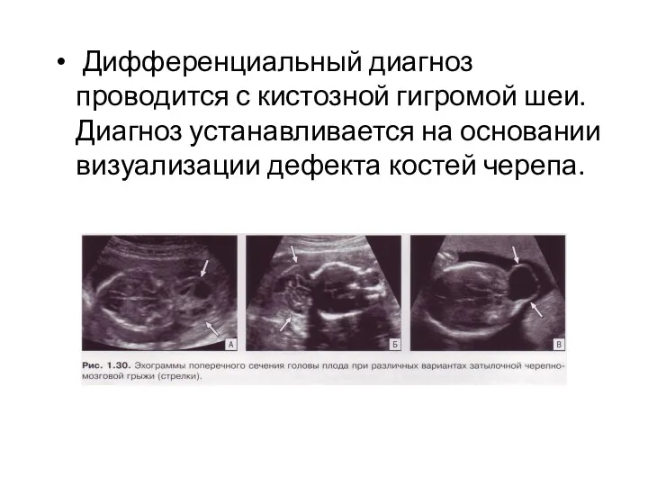 Дифференциальный диагноз проводится с кистозной гигромой шеи. Диагноз устанавливается на основании визуализации дефекта костей черепа.