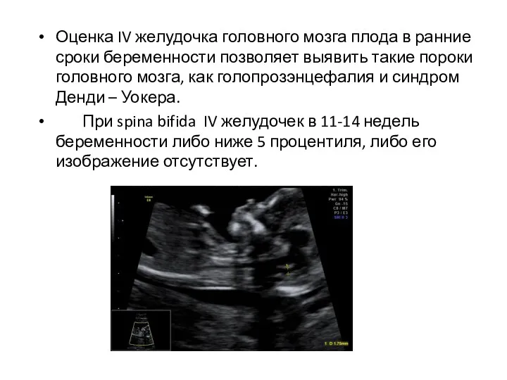 Оценка IV желудочка головного мозга плода в ранние сроки беременности