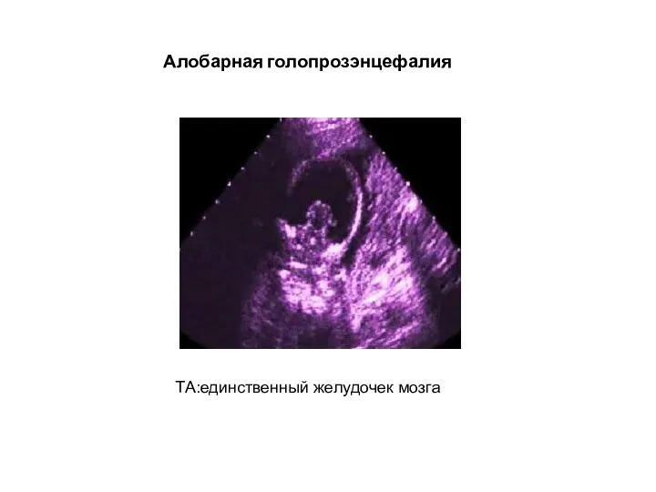 Алобарная голопрозэнцефалия ТА:единственный желудочек мозга