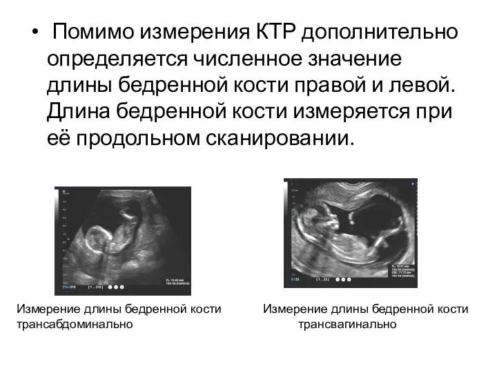 Помимо измерения КТР дополнительно определяется численное значение длины бедренной кости