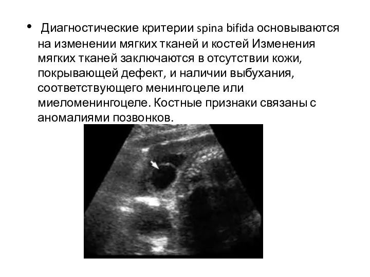 Диагностические критерии spina bifida основываются на изменении мягких тканей и