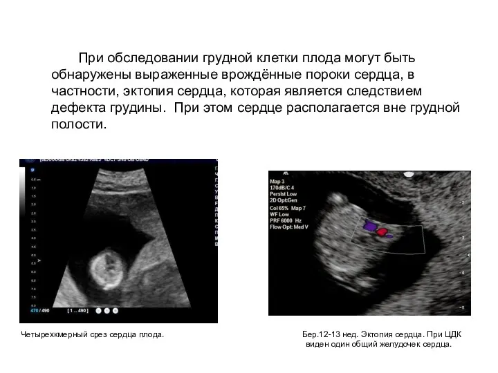 При обследовании грудной клетки плода могут быть обнаружены выраженные врождённые