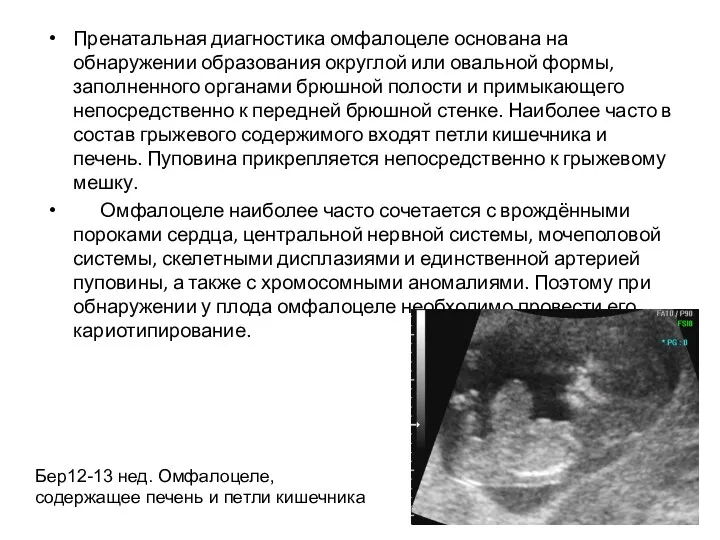 Пренатальная диагностика омфалоцеле основана на обнаружении образования округлой или овальной