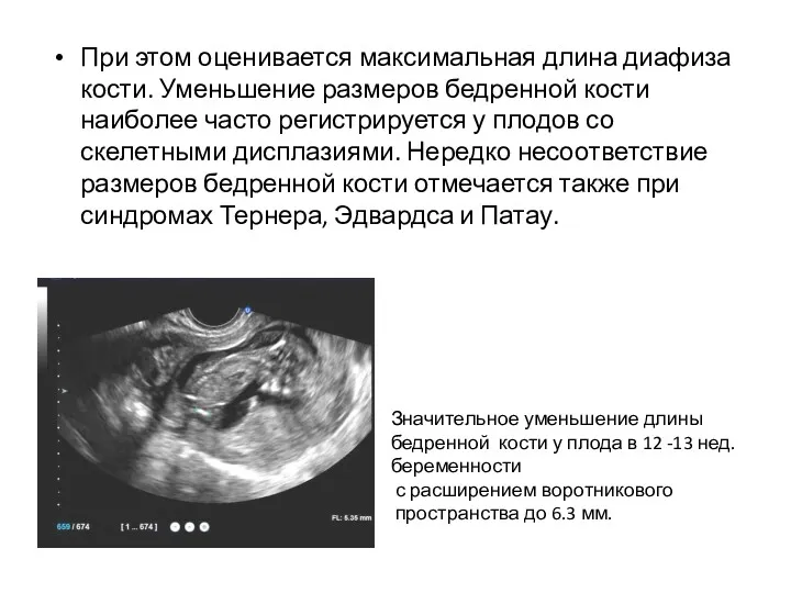 При этом оценивается максимальная длина диафиза кости. Уменьшение размеров бедренной