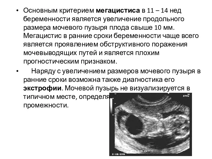 Основным критерием мегацистиса в 11 – 14 нед беременности является