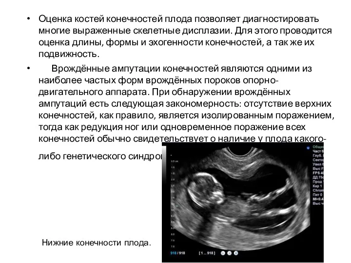 Оценка костей конечностей плода позволяет диагностировать многие выраженные скелетные дисплазии.