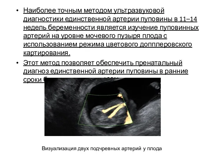 Наиболее точным методом ультразвуковой диагностики единственной артерии пуповины в 11–14