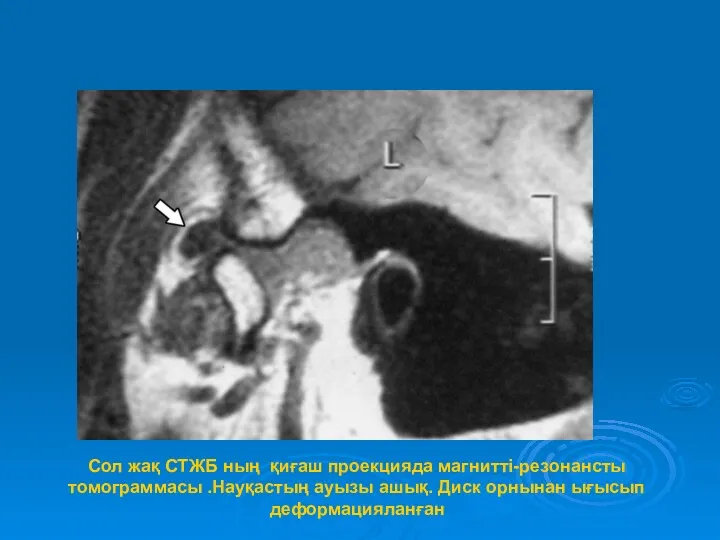 Сол жақ СТЖБ ның қиғаш проекцияда магнитті-резонансты томограммасы .Науқастың ауызы ашық. Диск орнынан ығысып деформацияланған