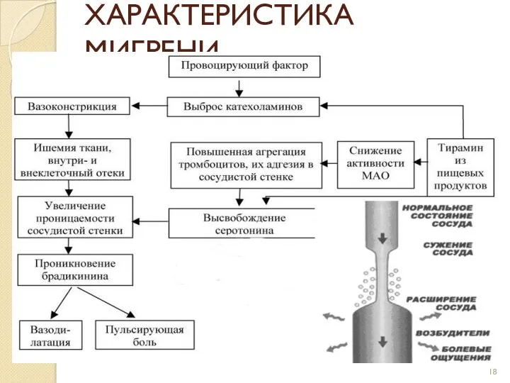 ХАРАКТЕРИСТИКА МИГРЕНИ