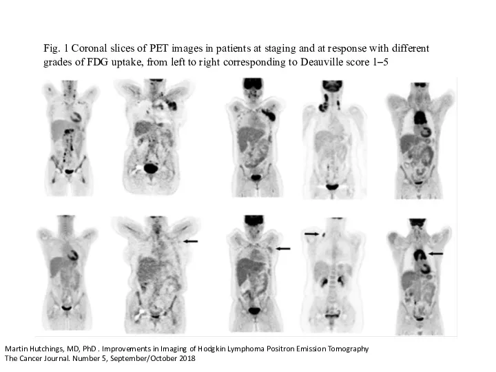 Fig. 1 Coronal slices of PET images in patients at