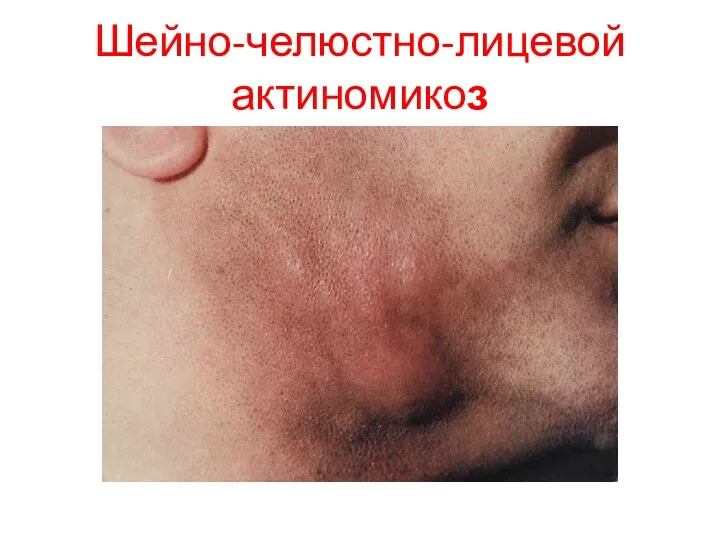 Шейно-челюстно-лицевой актиномикоз