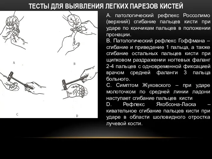 ТЕСТЫ ДЛЯ ВЫЯВЛЕНИЯ ЛЕГКИХ ПАРЕЗОВ КИСТЕЙ А. патологический рефлекс Россолимо