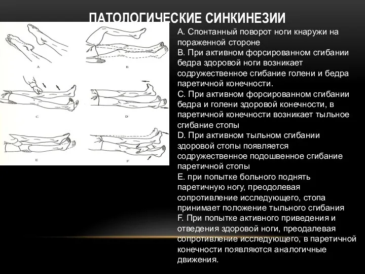 ПАТОЛОГИЧЕСКИЕ СИНКИНЕЗИИ А. Спонтанный поворот ноги кнаружи на пораженной стороне В. При активном