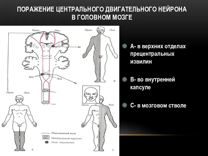 ПОРАЖЕНИЕ ЦЕНТРАЛЬНОГО ДВИГАТЕЛЬНОГО НЕЙРОНА В ГОЛОВНОМ МОЗГЕ А- в верхних отделах прецентральных извилин