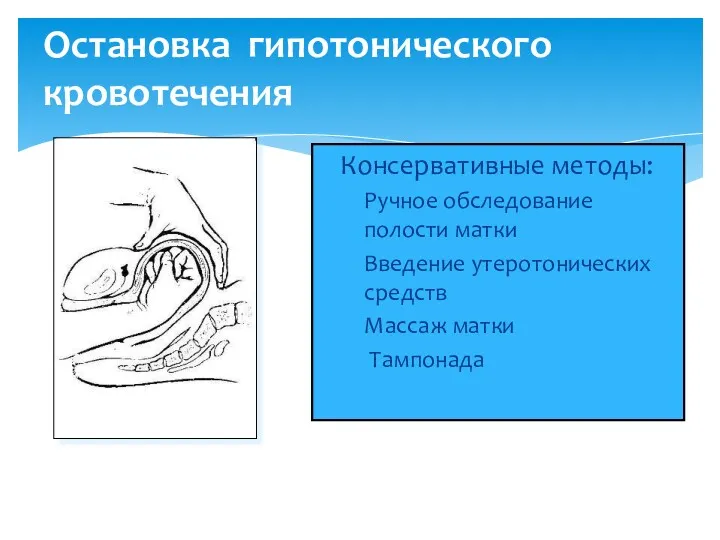 Остановка гипотонического кровотечения Консервативные методы: Ручное обследование полости матки Введение утеротонических средств Массаж матки Тампонада