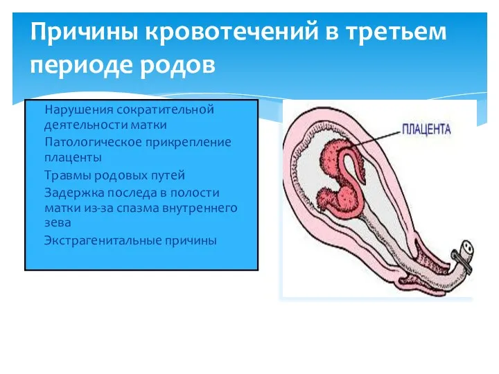 Причины кровотечений в третьем периоде родов Нарушения сократительной деятельности матки