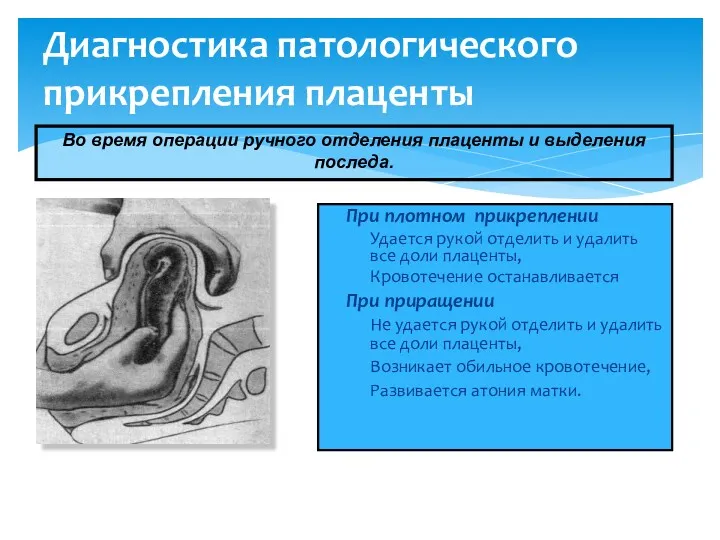 Диагностика патологического прикрепления плаценты При плотном прикреплении Удается рукой отделить