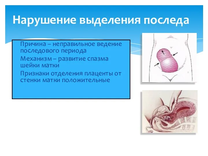 Нарушение выделения последа Причина – неправильное ведение последового периода Механизм