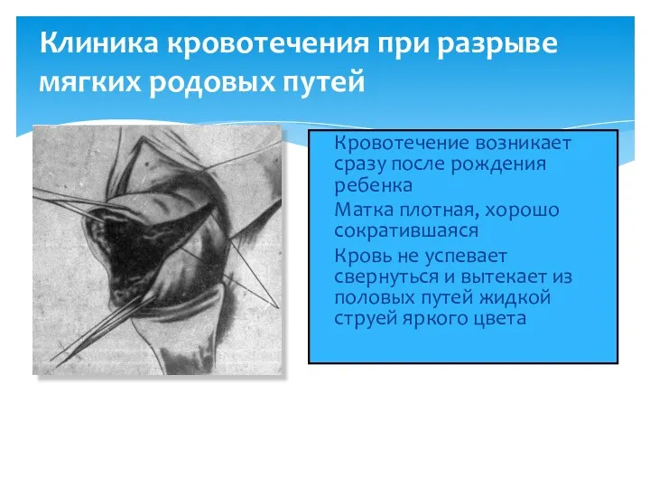 Клиника кровотечения при разрыве мягких родовых путей Кровотечение возникает сразу