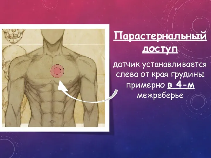 Парастернальный доступ датчик устанавливается слева от края грудины примерно в 4-м межреберье