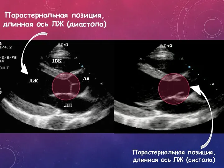 Парастернальная позиция, длинная ось ЛЖ (диастола) Парастернальная позиция, длинная ось ЛЖ (систола)