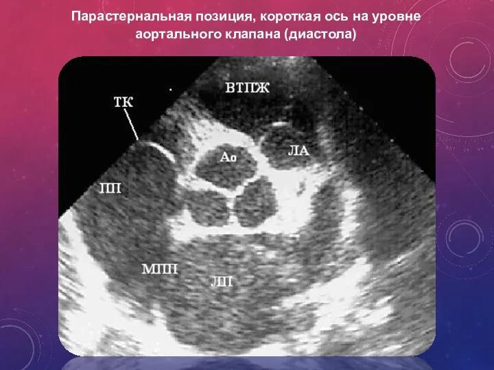 Парастернальная позиция, короткая ось на уровне аортального клапана (диастола)