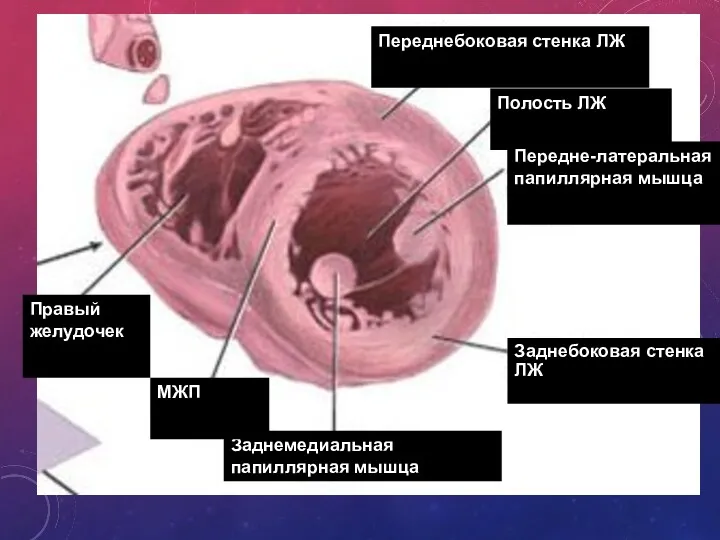 Переднебоковая стенка ЛЖ Полость ЛЖ Передне-латеральная папиллярная мышца Заднебоковая стенка ЛЖ Заднемедиальная папиллярная