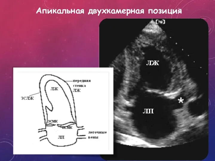 Апикальная двухкамерная позиция