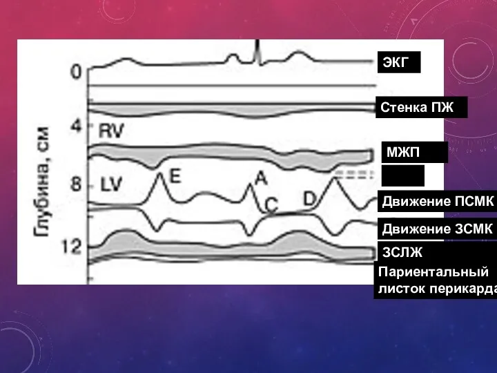ЭКГ Стенка ПЖ МЖП Движение ПСМК Движение ЗСМК ЗСЛЖ Париентальный листок перикарда