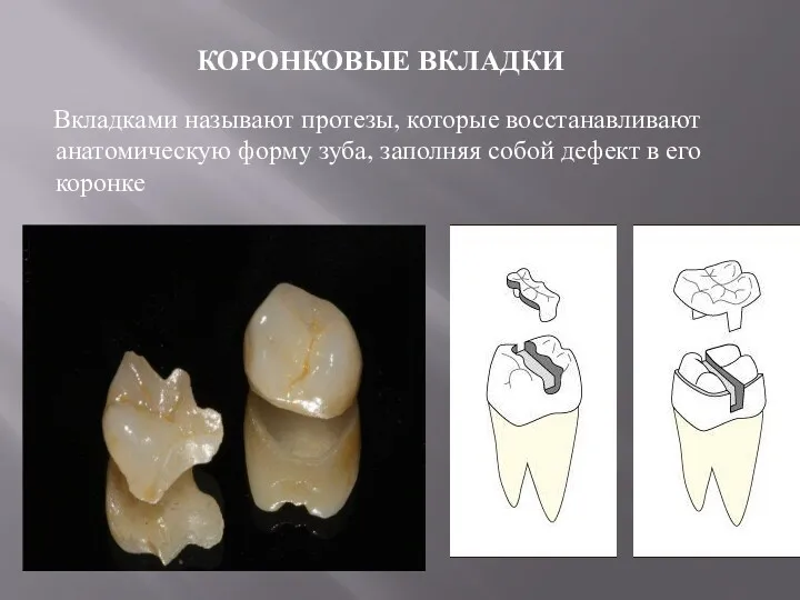 КОРОНКОВЫЕ ВКЛАДКИ Вкладками называют протезы, которые восстанавливают анатомическую форму зуба, заполняя собой дефект в его коронке