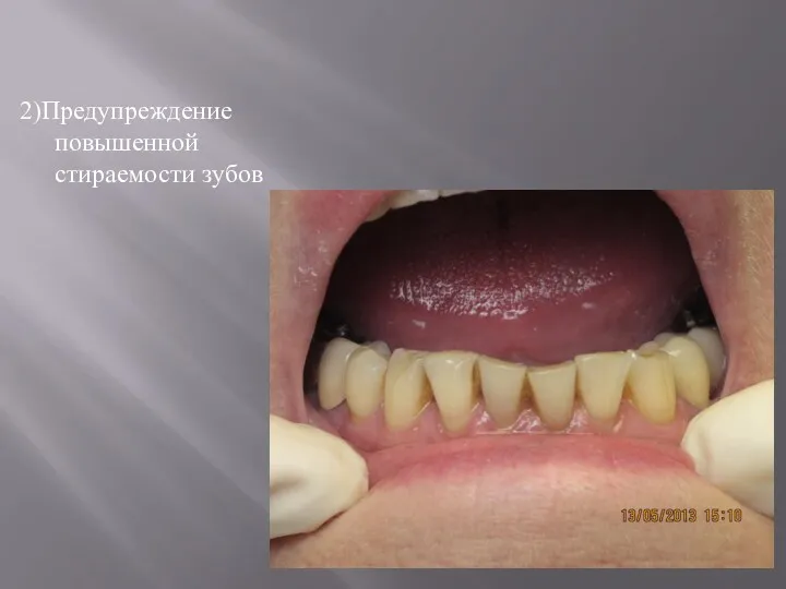 2)Предупреждение повышенной стираемости зубов