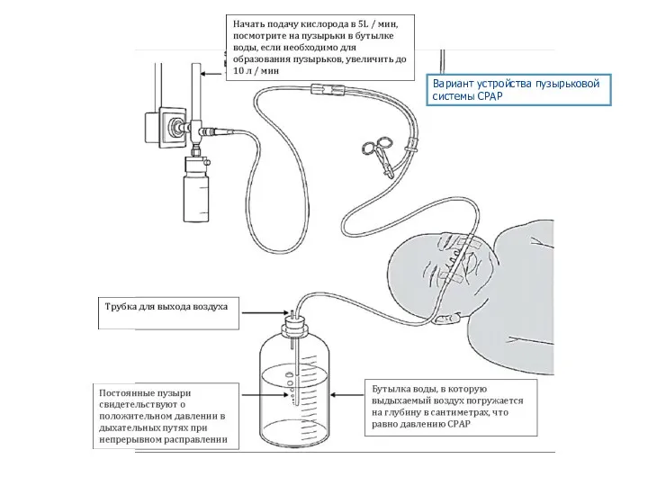 Вариант устройства пузырьковой системы CPAP