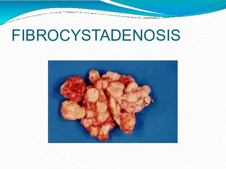 FIBROCYSTADENOSIS