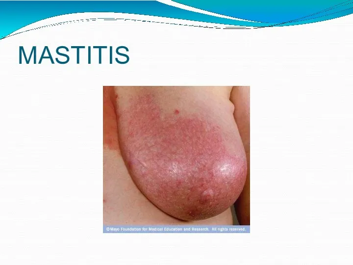 MASTITIS