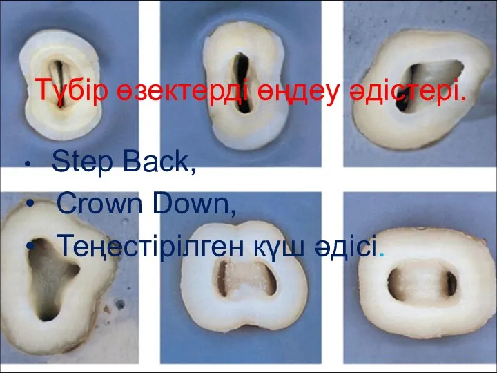 Түбір өзектерді өңдеу әдістері. Step Back, Crown Down, Теңестірілген күш әдісі.