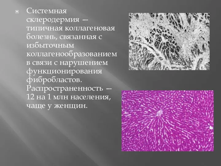 Системная склеродермия — типичная коллагеновая болезнь, связанная с избыточным коллагенообразованием