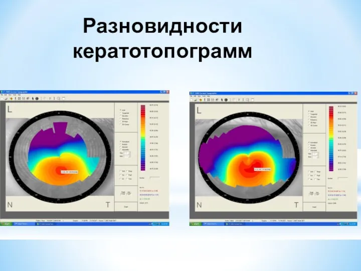 Разновидности кератотопограмм