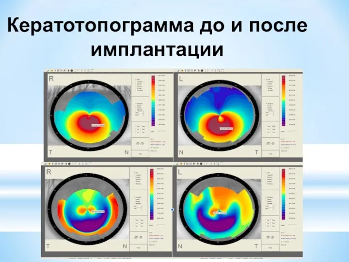 Кератотопограмма до и после имплантации