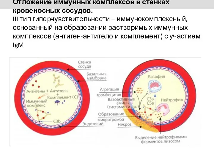 Отложение иммунных комплексов в стенках кровеносных сосудов. III тип гиперчувствительности – иммунокомплексный, основанный
